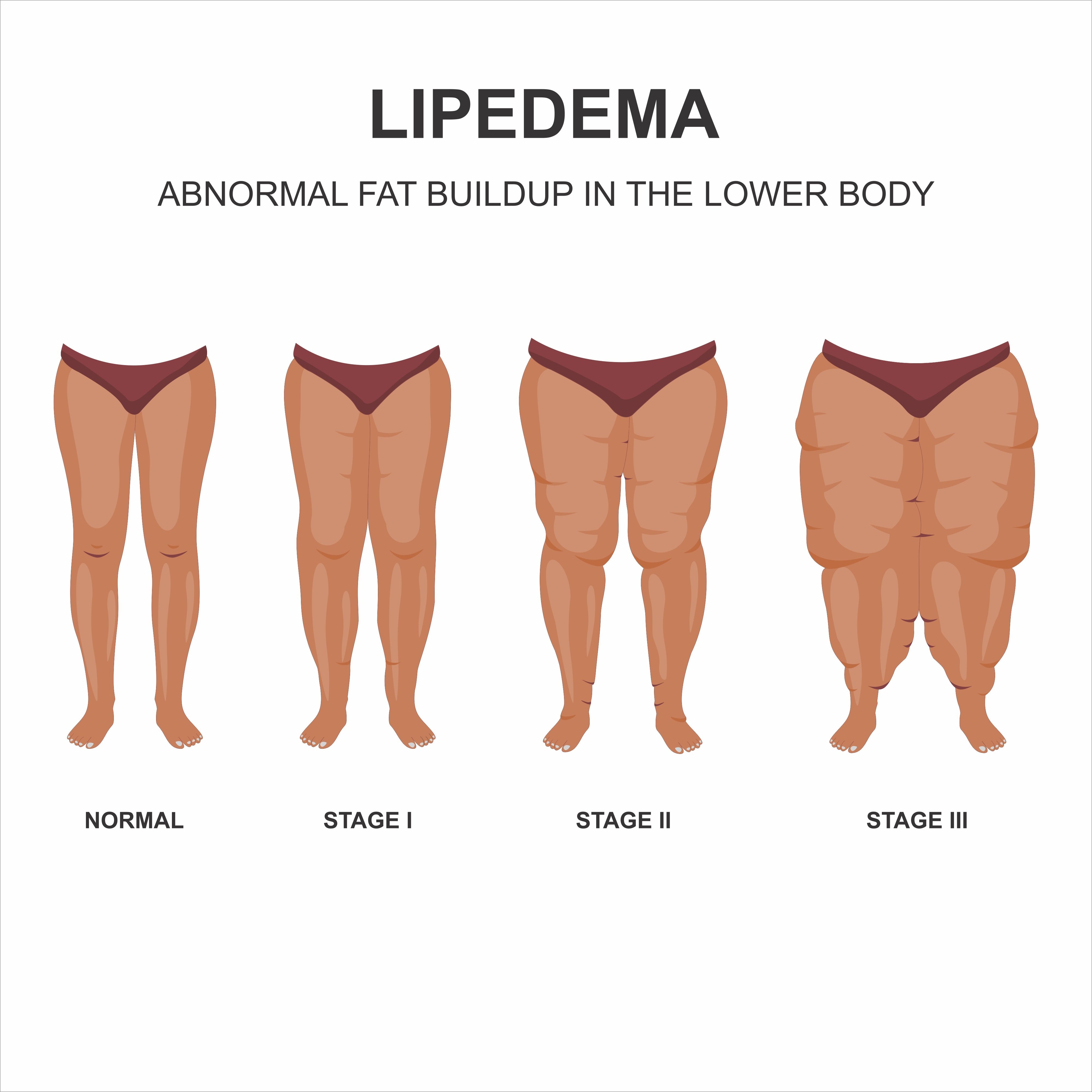 An image of the states of Lipedema.