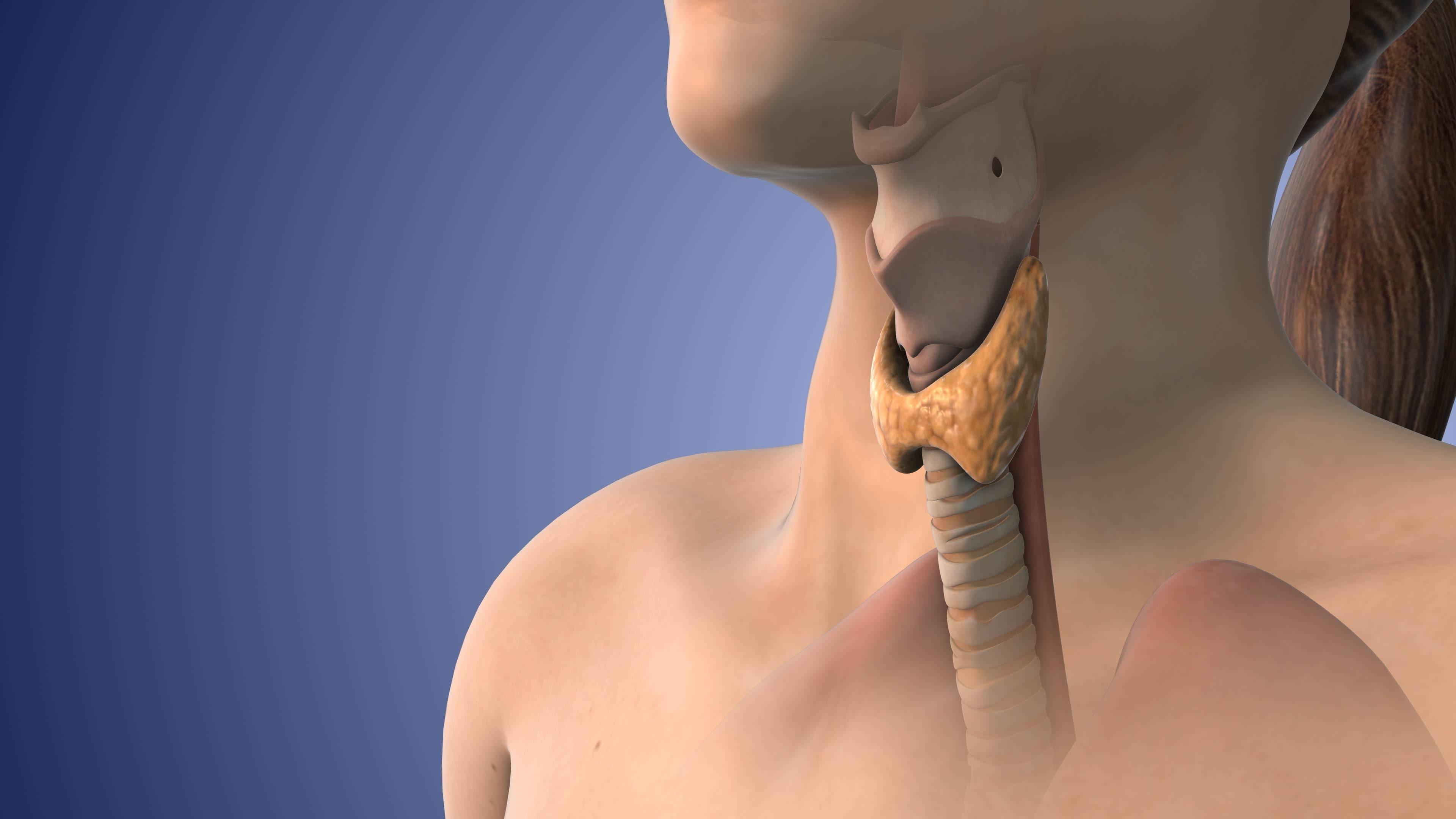 a medical image of a goiter, one of the early warning signs of thyroid problems.