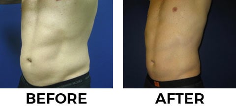 VASER Shape before and after example