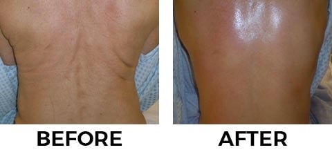 VASER Shape before and after example