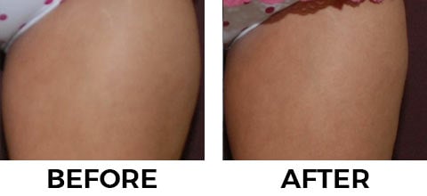 VASER Shape before and after example