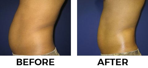 VASER Shape before and after example