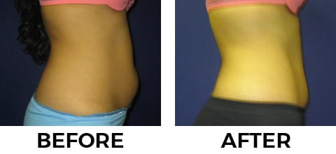 VASER Shape before and after example