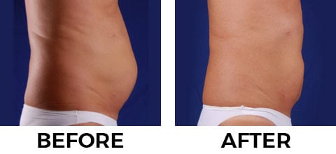 VASER Shape before and after example