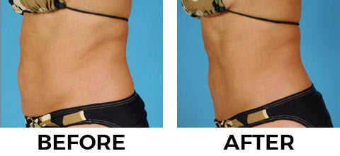 VASER Shape before and after example