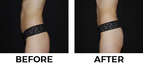 VASER Shape before and after example