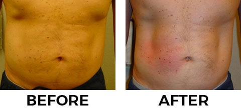 VASER Shape before and after example